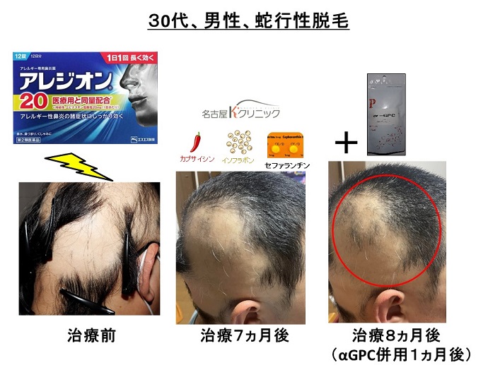 円形脱毛症　病院